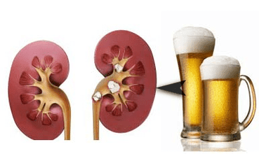 Het effect van alcohol op de nieren