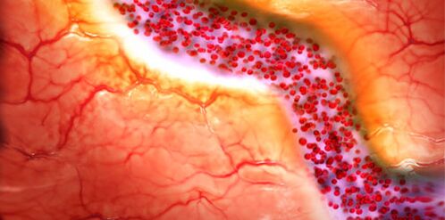 myocardiale vernietiging door alcohol